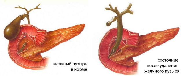 Дисфункция сфинктера одди и синдром избыточного бактериального роста в кишечнике