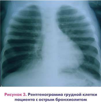 Обструктивный бронхит у детей