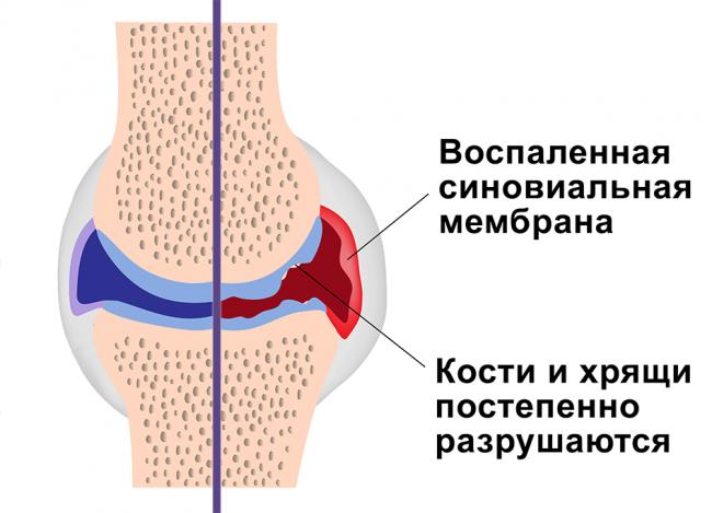 Синовит тазобедренного сустава