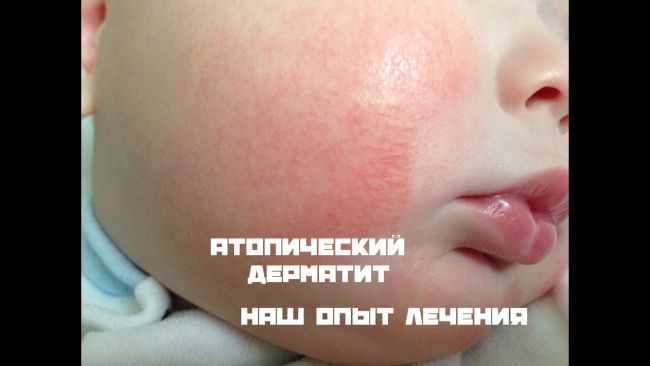 Аллергический дерматит. лечение у взрослых, причины, симптомы на руках, голове, лице. диета, мази, препараты в таблетках