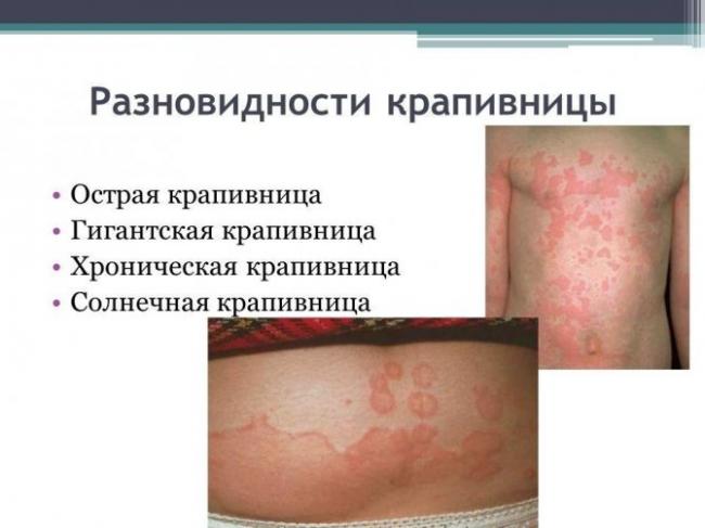 Аллергическая крапивница — причины, симптомы, диагностика и лечение