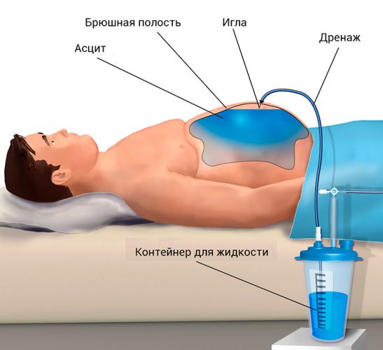 Пункция брюшной полости (лапароцентез). лапароцентез: показания и техника выполнения лапароцентез показания методика проведения