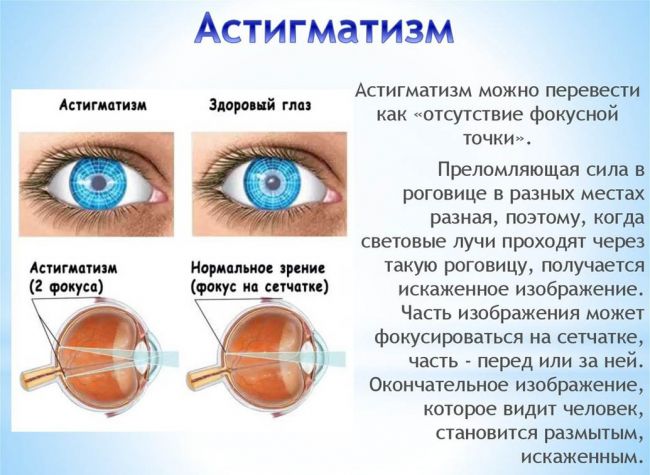 Ограничения при высокой степени миопии и способы ее лечения