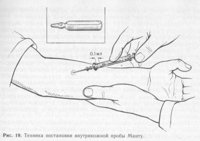 Размеры манту у детей в 14 лет: какова же норма реакции?