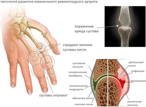 Micoderm от грибка: мгновенно действует, активно уничтожая микробы!