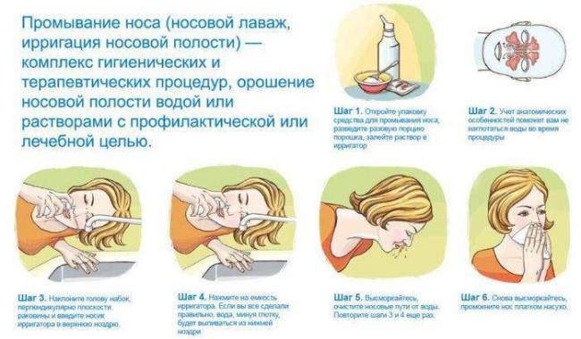 Как быстро вылечить гайморит в домашних условиях у взрослого
