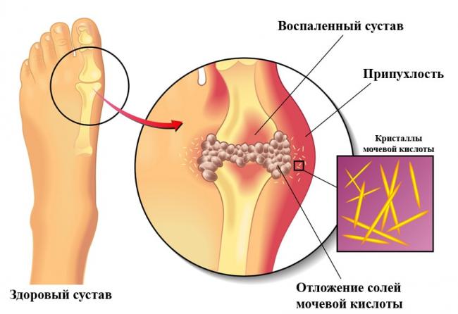 Лечение артрита коленного сустава