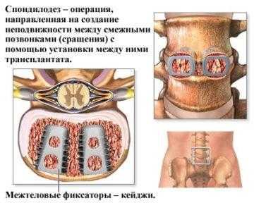 Эффективность оперативного лечения грыжи межпозвоночного диска