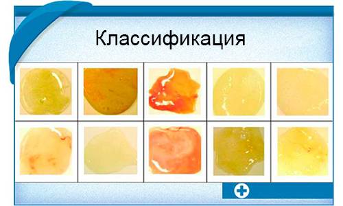 Цвета мокроты при кашле и их значение в диагностике