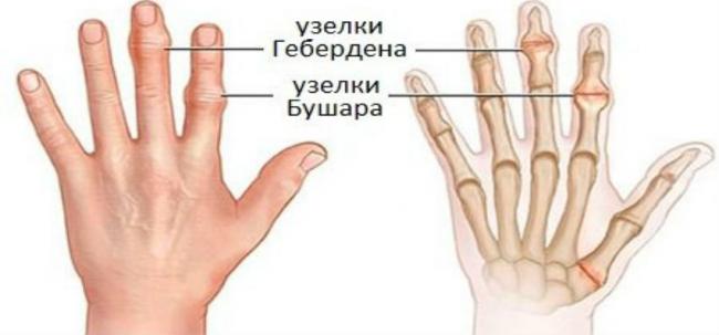 Ревматоидный артрит пальцев рук — первые симптомы, методы лечения
