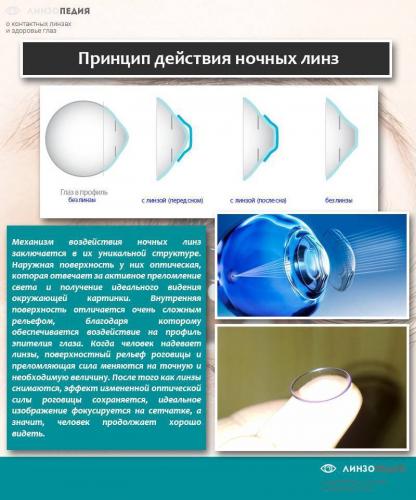 Ночные линзы для восстановления зрения: чудо офтальмологии или польза не для всех