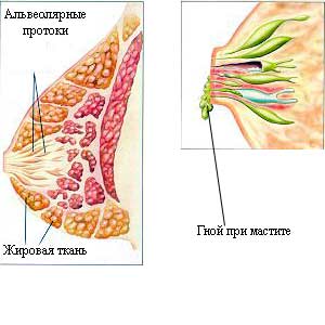 Мастит