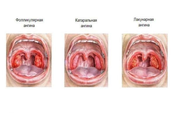 Какими антибиотиками лечат хронический тонзиллит
