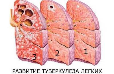 Что такое туберкулез?