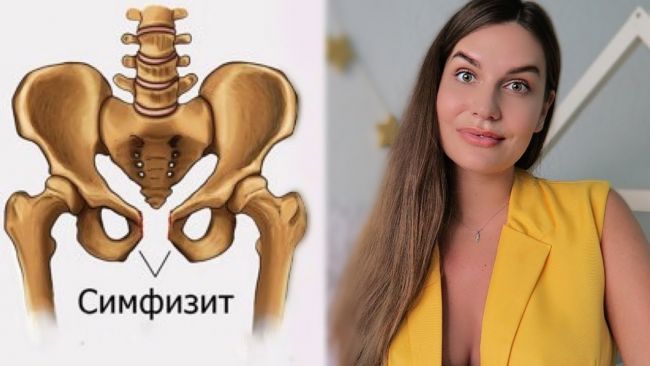 Симфизит после родов: лечение, симптомы, последствия
