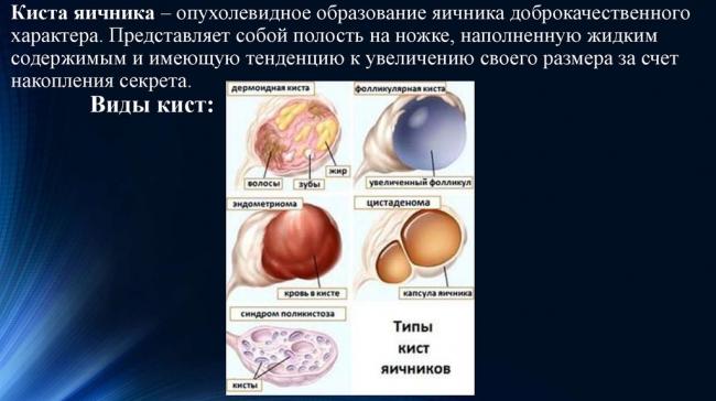 Что такое жидкостные образования в яичниках