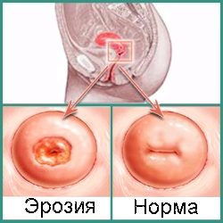 Все о эрозии шейки матки