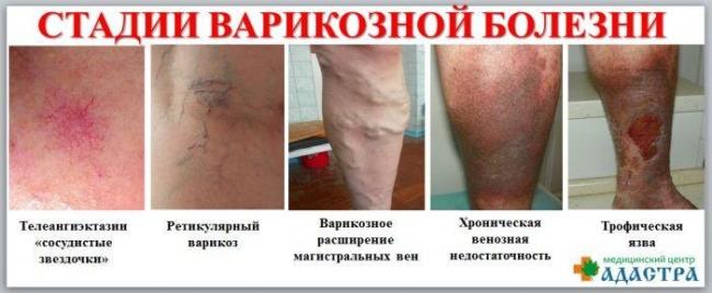 Флебит