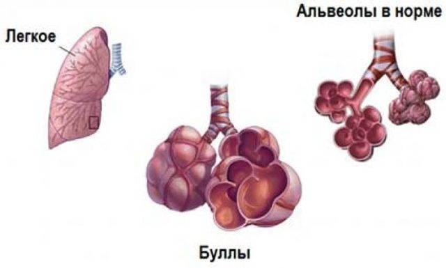 Буллезная болезнь легких – мкб-10 код: эмфизема