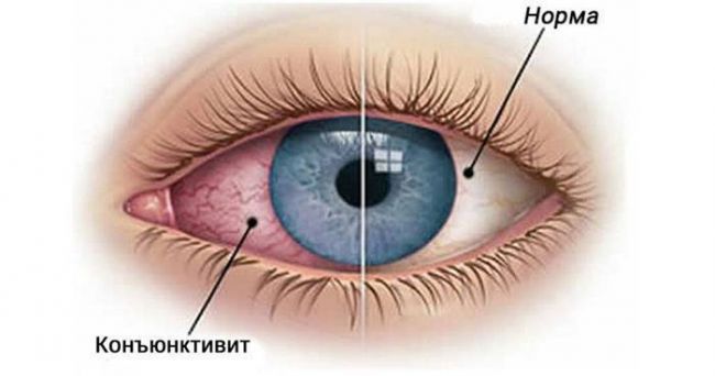Как быстро вылечить конъюнктивит у детей в домашних условиях аптечные капли и народные средства