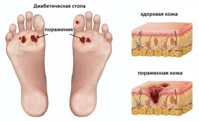 Симптомы и лечение диабетической полинейропатии нижних конечностей: методы и препараты