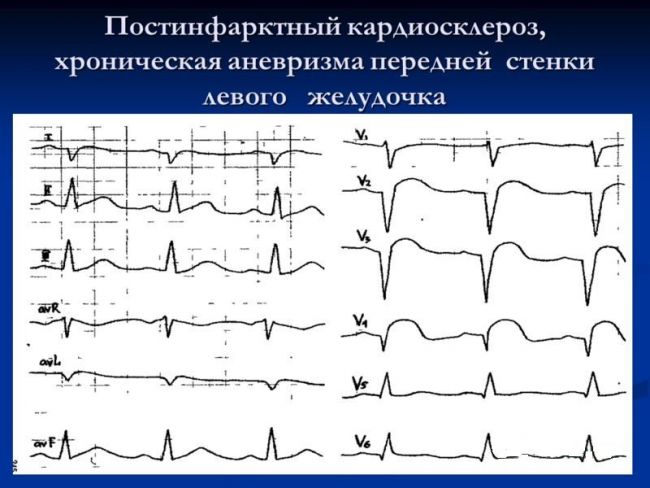 Атеросклеротический кардиосклероз: причины заболевания, основные симптомы, лечение и профилактика