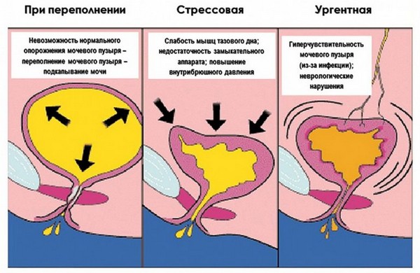 Энурез — что это такое и как избавиться от ночного недержания мочи