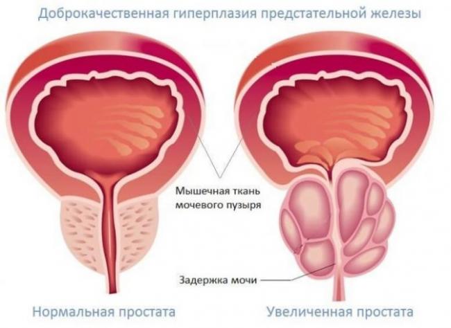 Суточный диурез