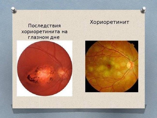 Хориоретинит глаза: что это такое, виды (центральный серозный, токсоплазмозный, туберкулезный, сифилитический, острый, очаговый), причины, симптомы, лечение, диагностика, осложнения, берут ли в армию