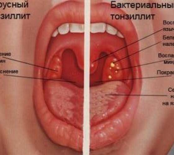 Антибиотики при ангине у детей: какой лучше подходит для лечения, названия детских препаратов