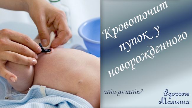 Решаем проблему: что делать, если у новорожденного кровит пупок
