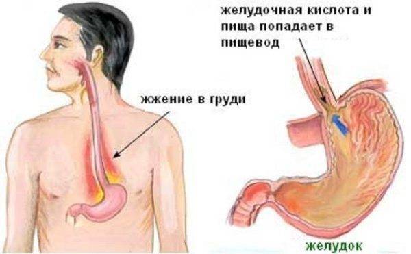 Чувство жжения в горле