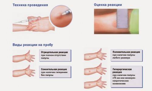 Что делать если у ребенка положительная реакция манту и как выглядит плохая проба