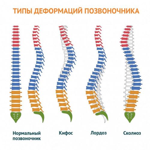 Что такое клинья позвоночника