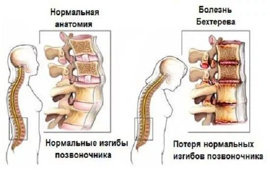 Болезнь бехтерева - симптомы и лечение