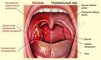 Ангина без температуры, или язвенно некротическая ангина венсана – плаута – симановского