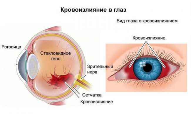 Лопнул капилляр в глазу: причины, симптомы, лечение