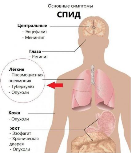 Очаговый туберкулез легких: симптомы, лечение | eurolab | инфекционные болезни