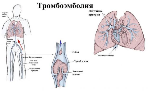 Мокрота с кровью при кашле по утрам