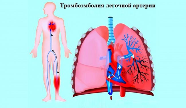 Причина образования тромбов в сосудах человека