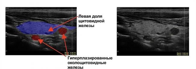 Кистозные заболевания почек