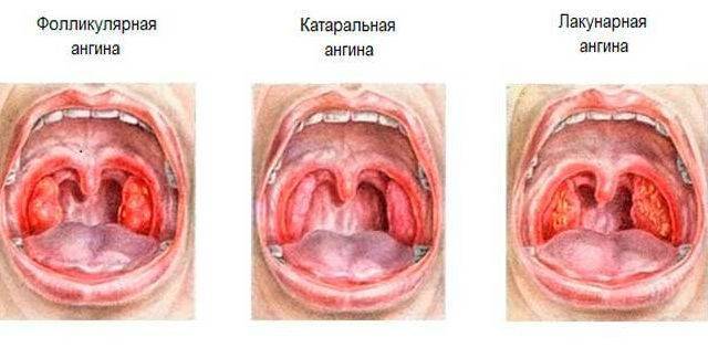 Острый тонзиллит: лечение, симптомы, осложнения