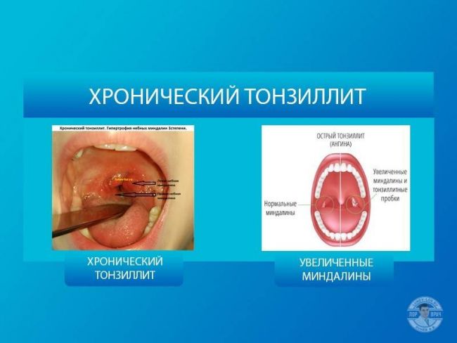 Болезни горла и гортани: какие бывают (список), симптомы и лечение