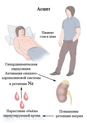 Асцит брюшной полости при онкологии