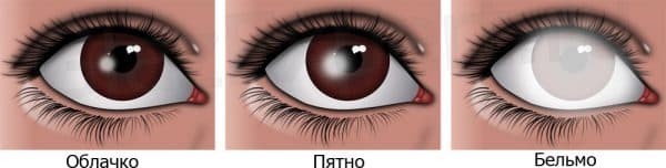 Бельмо на глазу у человека