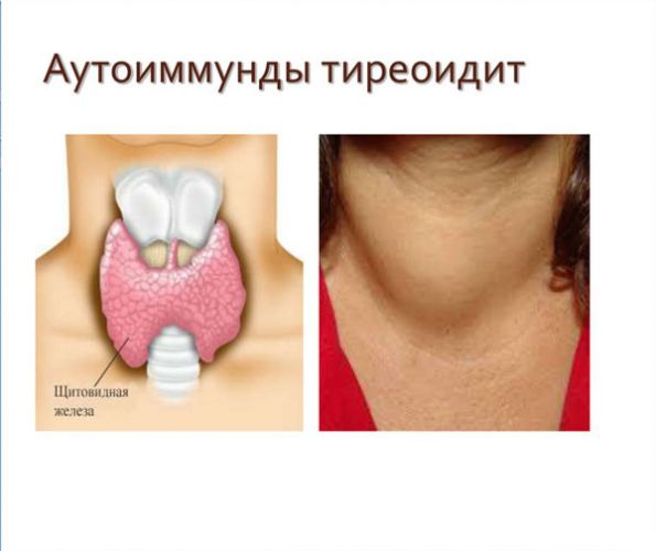 Психиатрические расстройства: щитовидная железа может быть причиной