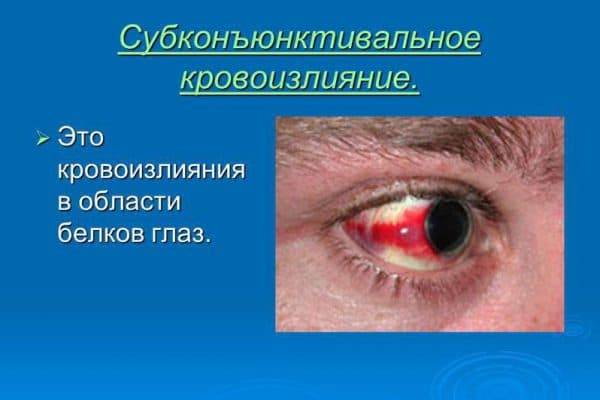 Лечение кровоизлияния в стекловидное тело, в глаз