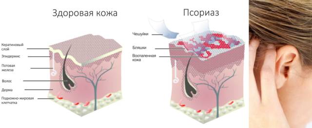Противогрибковые капли для лечения ушей