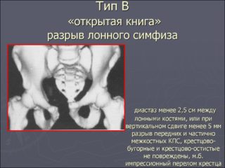 Послеродовой симфизит: причины, признаки, методы борьбы