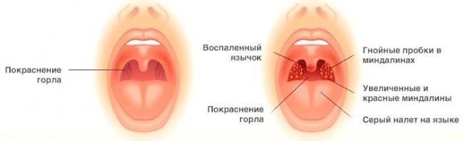 Комаровский – боль в горле, горло красное, что делать, если у ребенка рыхлое горло, лечение